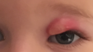 Foto (kleur) zwelling ooglid
